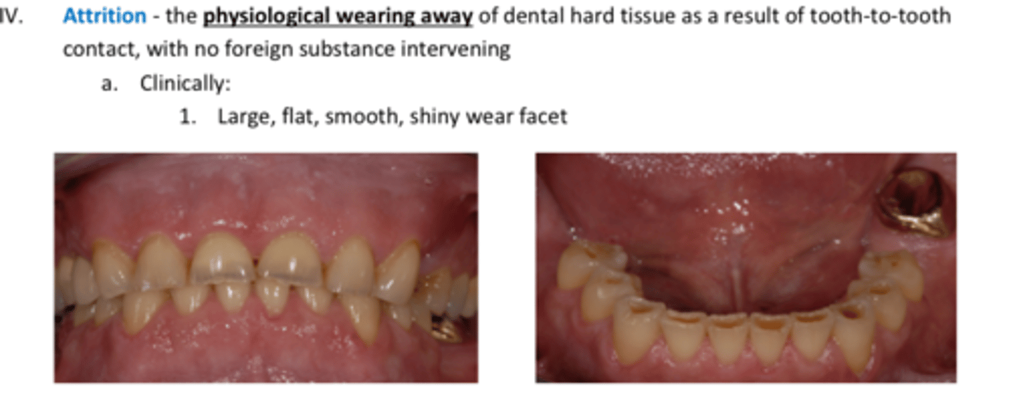 <p>The physiological wearing away of dental hard tissue as a result of tooth-to-tooth contact, with no foreign substance intervening</p><p>Clinically: </p><p>Large, flat, smooth, shiny wear facet</p>