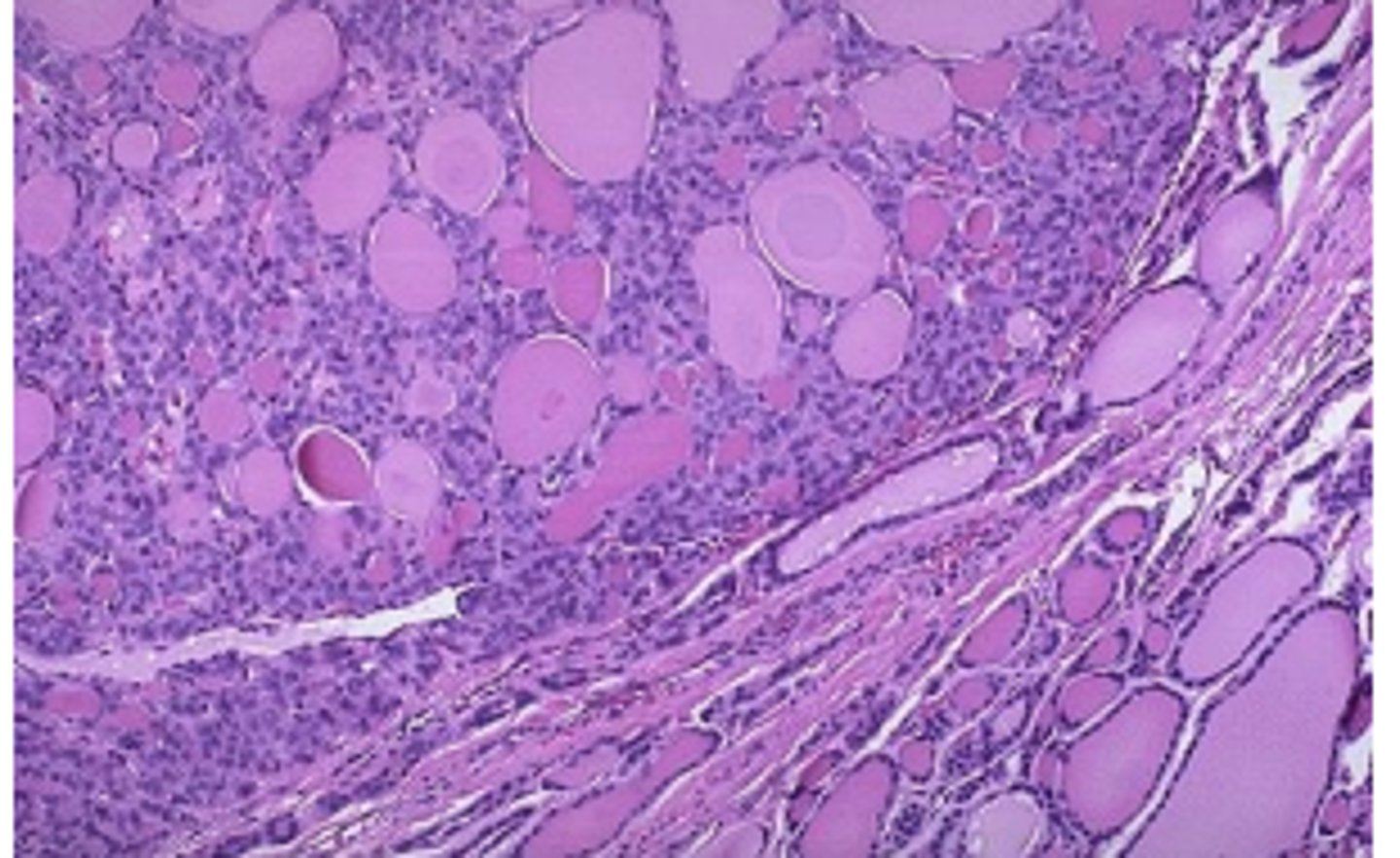 <p>most common subtype of follicular adenoma</p>