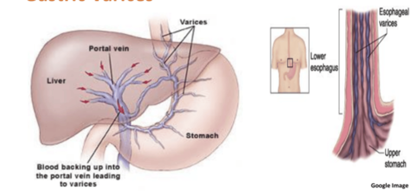 <p>-portal hypertension</p><p>-esophageal and gastric varices</p>