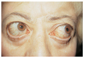 <ul><li><p><span style="background-color: transparent;"><span> Graves’ disease is an </span><u><span>autoimmune</span></u><span> disorder</span></span></p></li><li><p><span style="background-color: transparent;"><span> It is characterized by hypersecretion of thyroid hormone (</span><strong><u><span>hyperthyroidism</span></u></strong><span>)</span></span></p></li><li><p><span style="background-color: transparent;"><span>Can cause what is called a </span><u><span>Toxic Goiter</span></u></span></p></li><li><p><span style="background-color: transparent;"><span>Is often associated with exophthalmos, also know as </span><u><span>proptosis</span></u></span></p></li></ul><p></p>