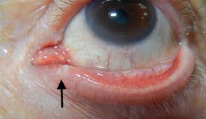 <p>Small opening on the medial aspect of the eyelid margin that serves as an opening for lacrimal ducts</p>