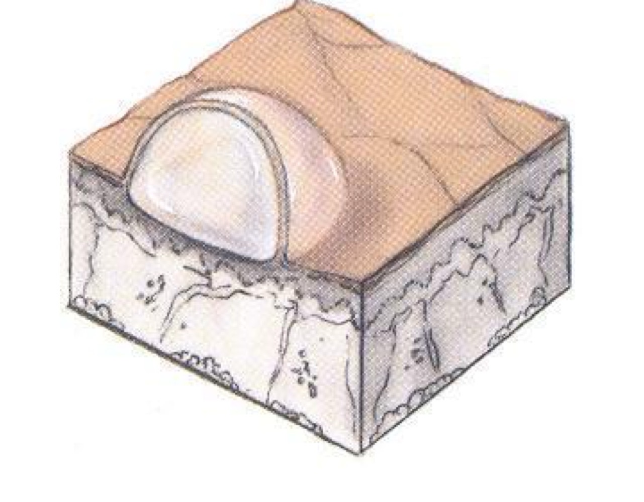 <p>what type of skin lesion is this? </p>