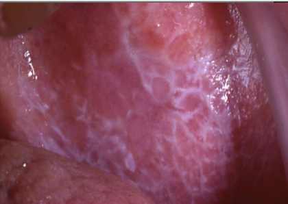 <p>An immune mediated, benign, chronic dermatologic disease that often affects oral mucosa</p>