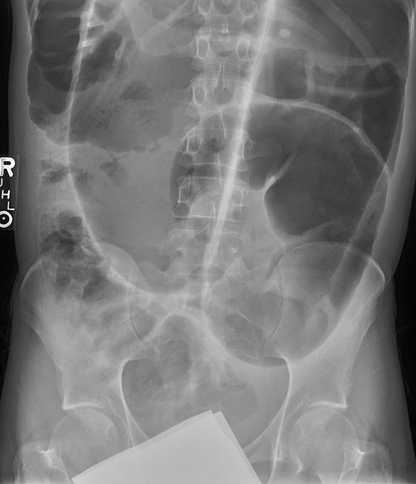 <p>Which age group commonly experiences sigmoid volvulus?</p>