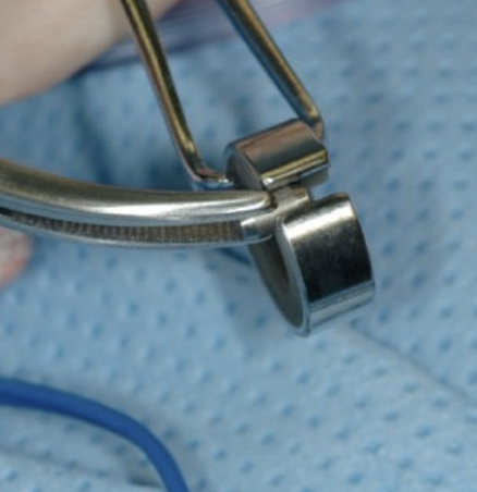 <p>- It has an inner ring of casein, a hygroscopic substance that swells as it slowly absorbs body fluid and reduces the inner ring diameter leading to thrombus formation of the vessel</p><p>- +/- outer ring of stainless steel</p>