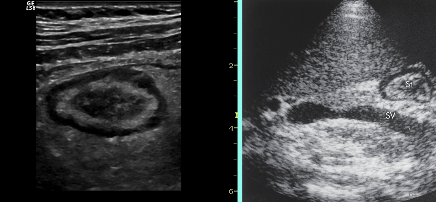 <p>thickest layers are the echogenic submucosa surrounded by hypoechoic muscularis propia </p>