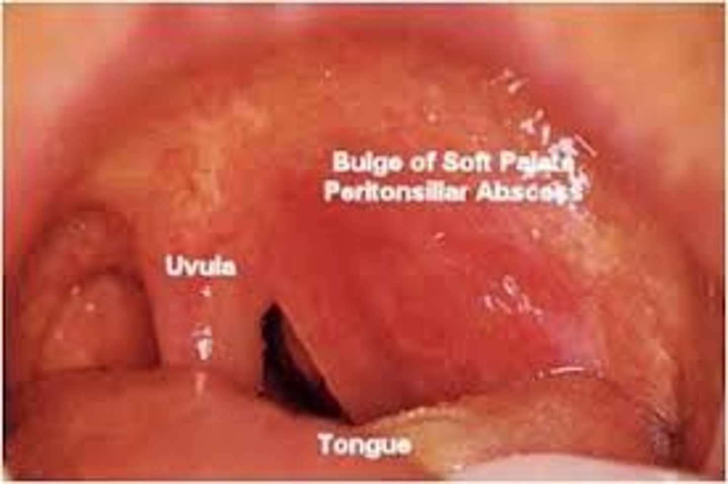 <p>peritonsillar abscess but need CT scan to differentiate b/t cellulitis vs abscess</p>