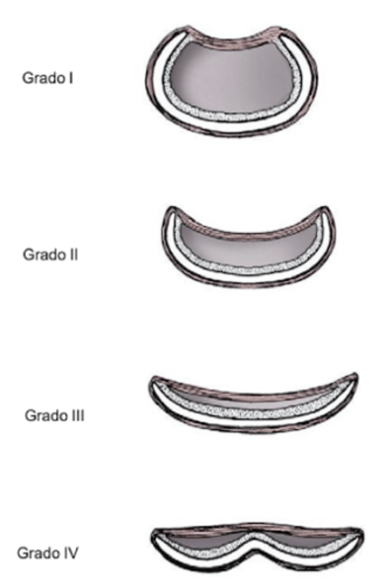 <p>colapso traqueal</p>