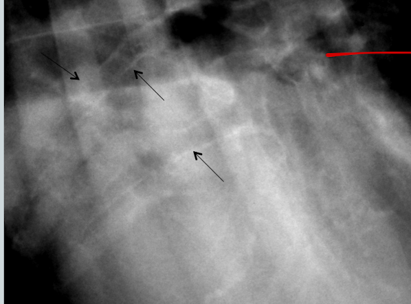 <p>What lung pattern? What are the arrows pointing to? </p>