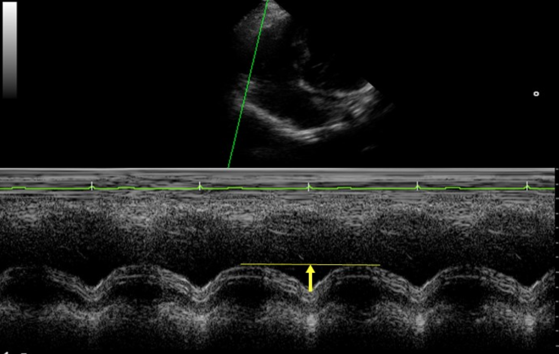 <p>Measurement performed to determine RV systolic function </p>