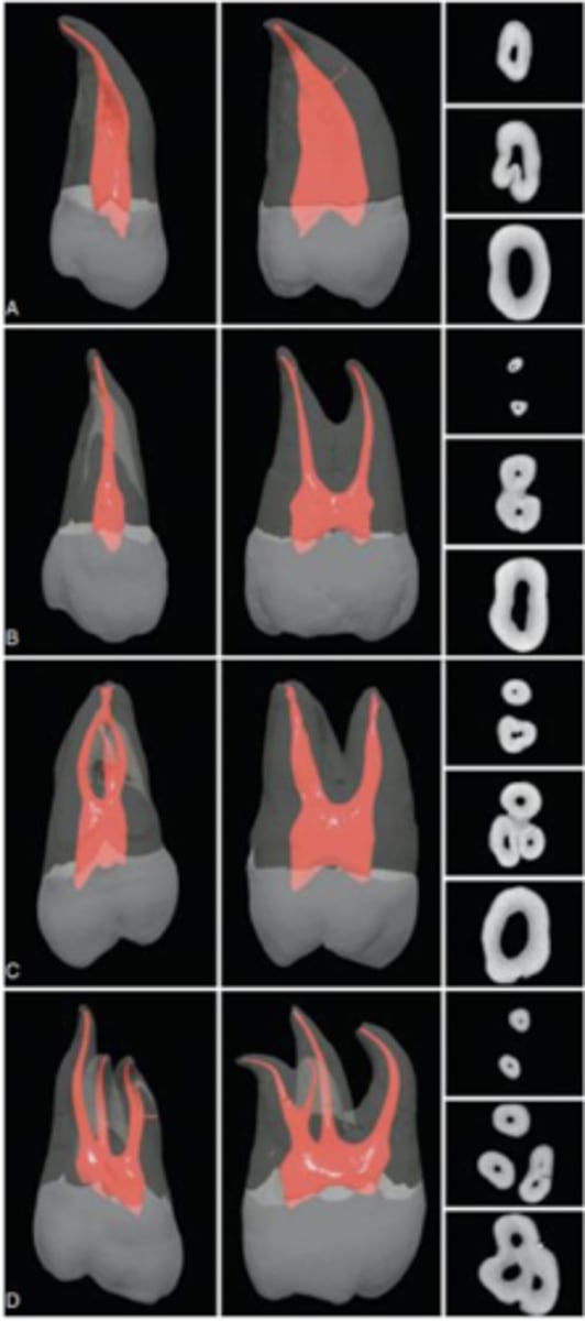 <p>maxillary 3rd molar</p>