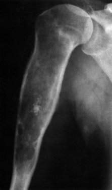 <p>Chondrosarcoma (tumor)</p>