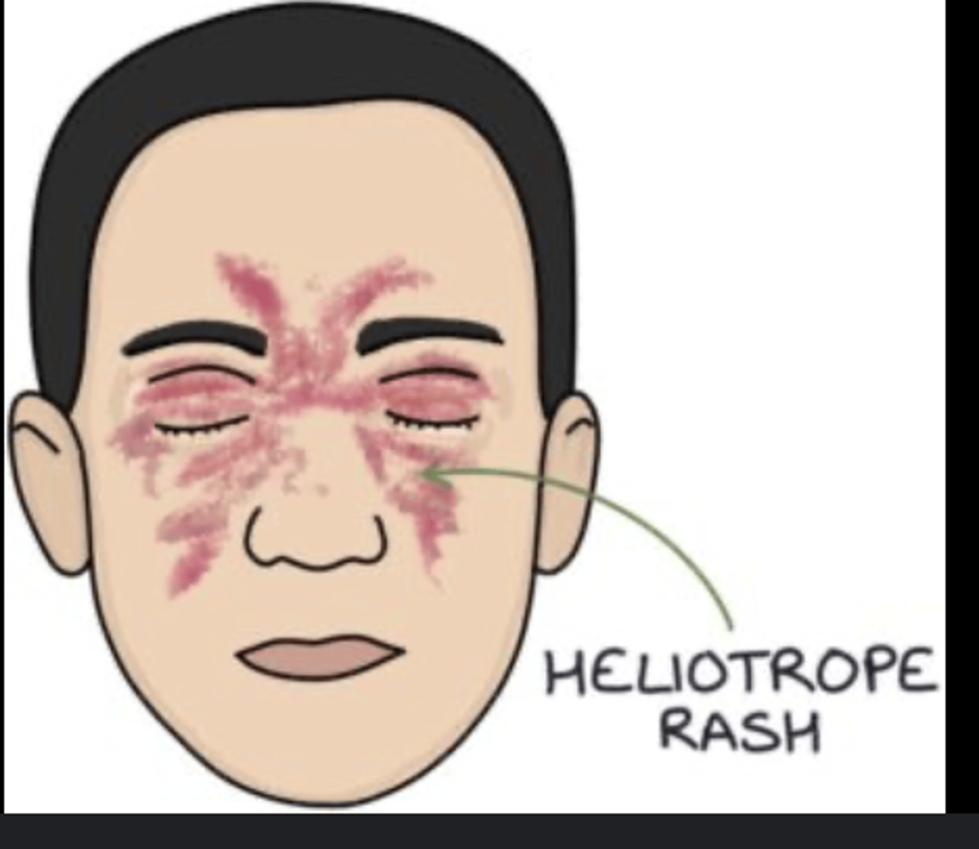 <p>inflammatory disorder causing symmetrical, proximal muscle weakness</p><p>dermatomyositis is a variant of the disease where skin manifestations are prominent - eg a light purple (heliotrope) rash on the cheeks and eyelids.</p><p>Gotrans sign as well - which is rash on knuckles</p><p>- associated with malignancy, so should do a CT CAP</p><p>- can result in type 2 resp failure!</p><p>- anti -Jo antibodies</p>