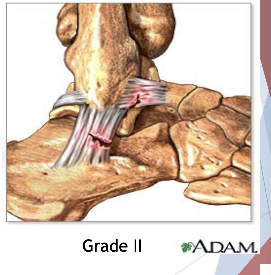 <p>2nd degree sprain</p>