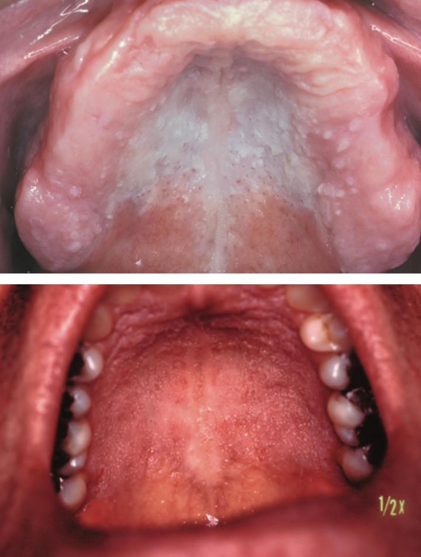 <p>which hereditary lesion:</p>