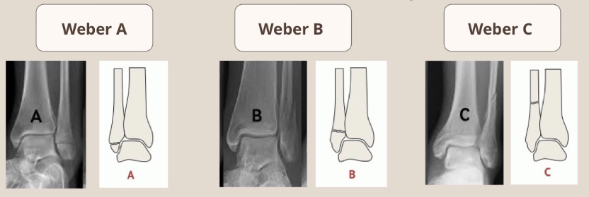 <p>A = Below the level of the syndesmosis (good prognosis)</p><p>B = at the level of the syndesmosis</p><p>C = above the level of the syndesmosis (makes the joint unstable, requires surgery)</p>