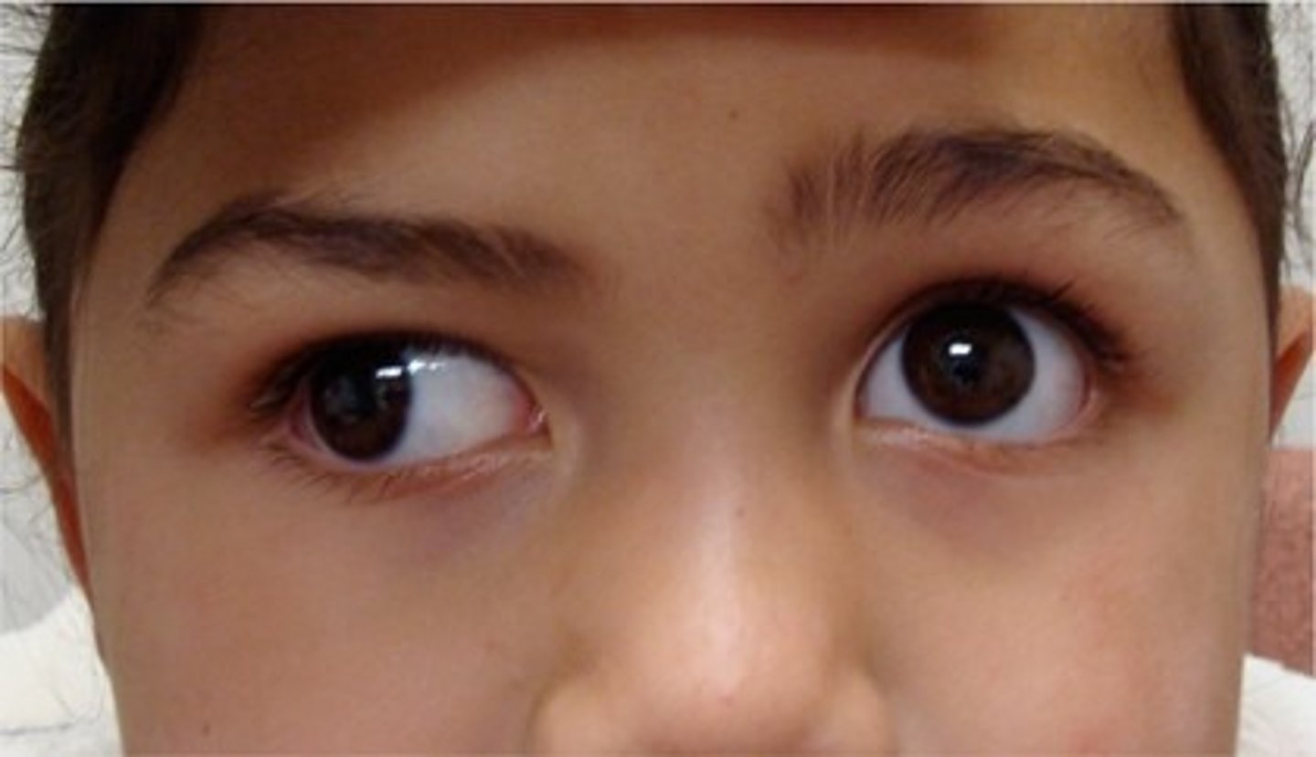 <p>condition where one or both eyes turn inward " wall-eyed appearance"</p>