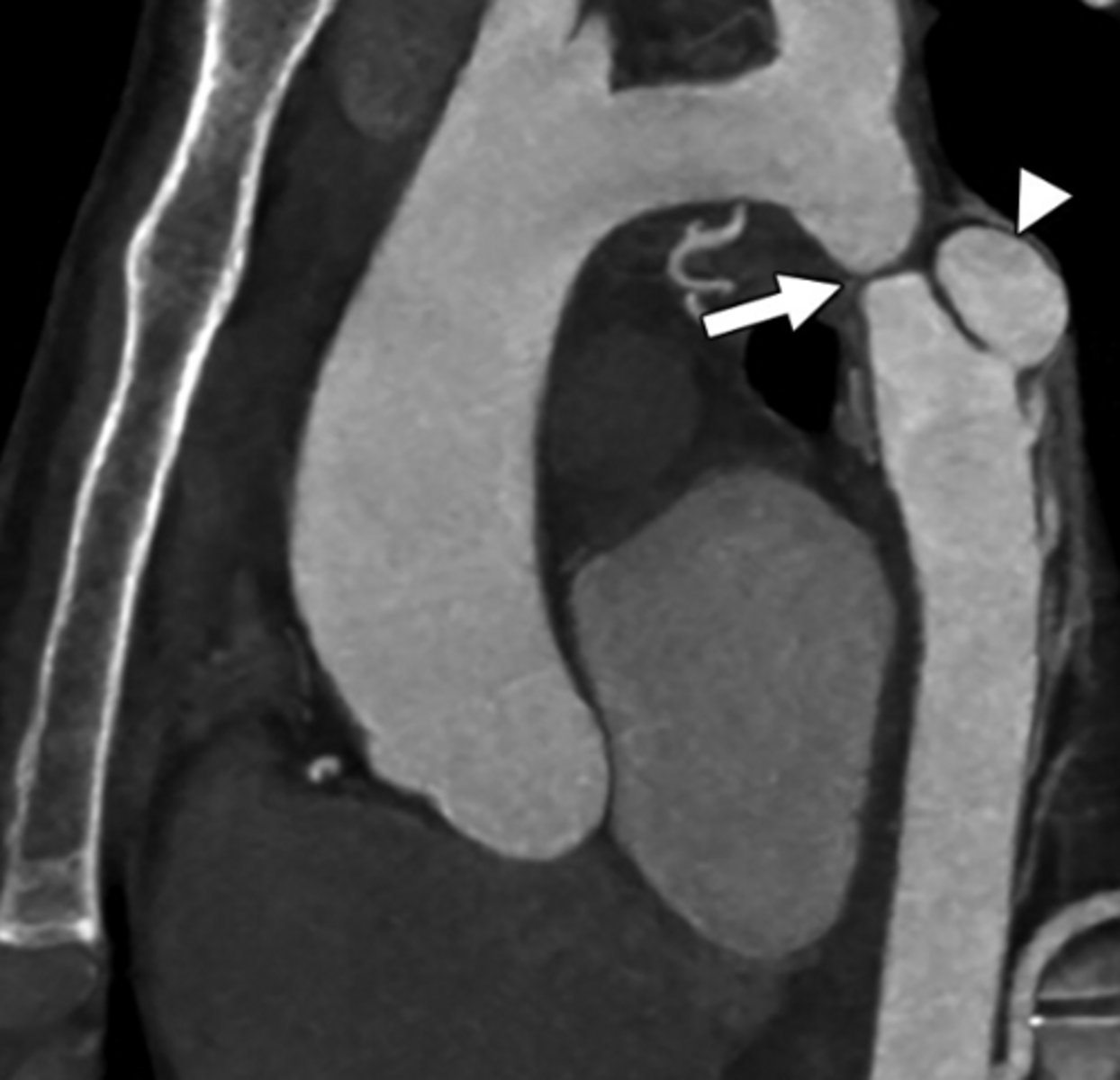 <p>Congenital narrowing of the aorta.</p>