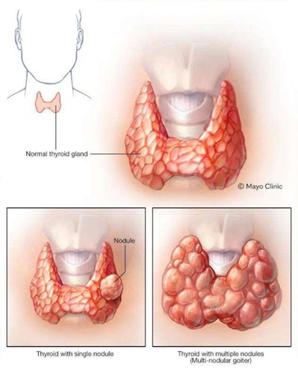<p>An enlargement of the thyroid gland.</p>