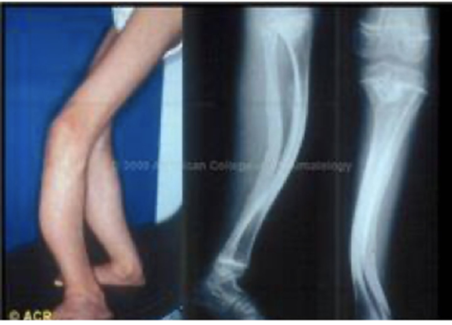 <p>En genetisk sjukdom orsakad av mutationer i kollagengenen som leder till defekter i benvävnaden och gör det skört</p>