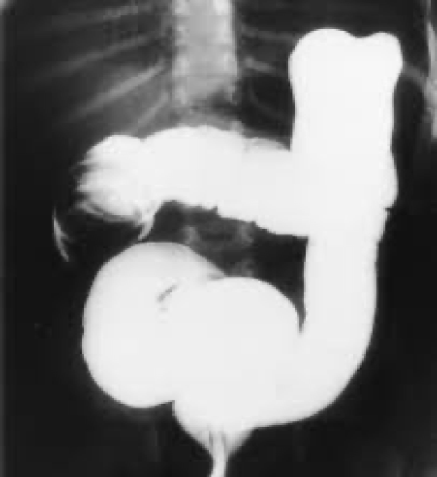 <p>Major cause of bowel obstruction in children</p><p>Telescoping/prolapse of one part of the intestines into another</p><p>Can affect vascular supply or necrosis</p><p>Usually by ileocecal valve</p>