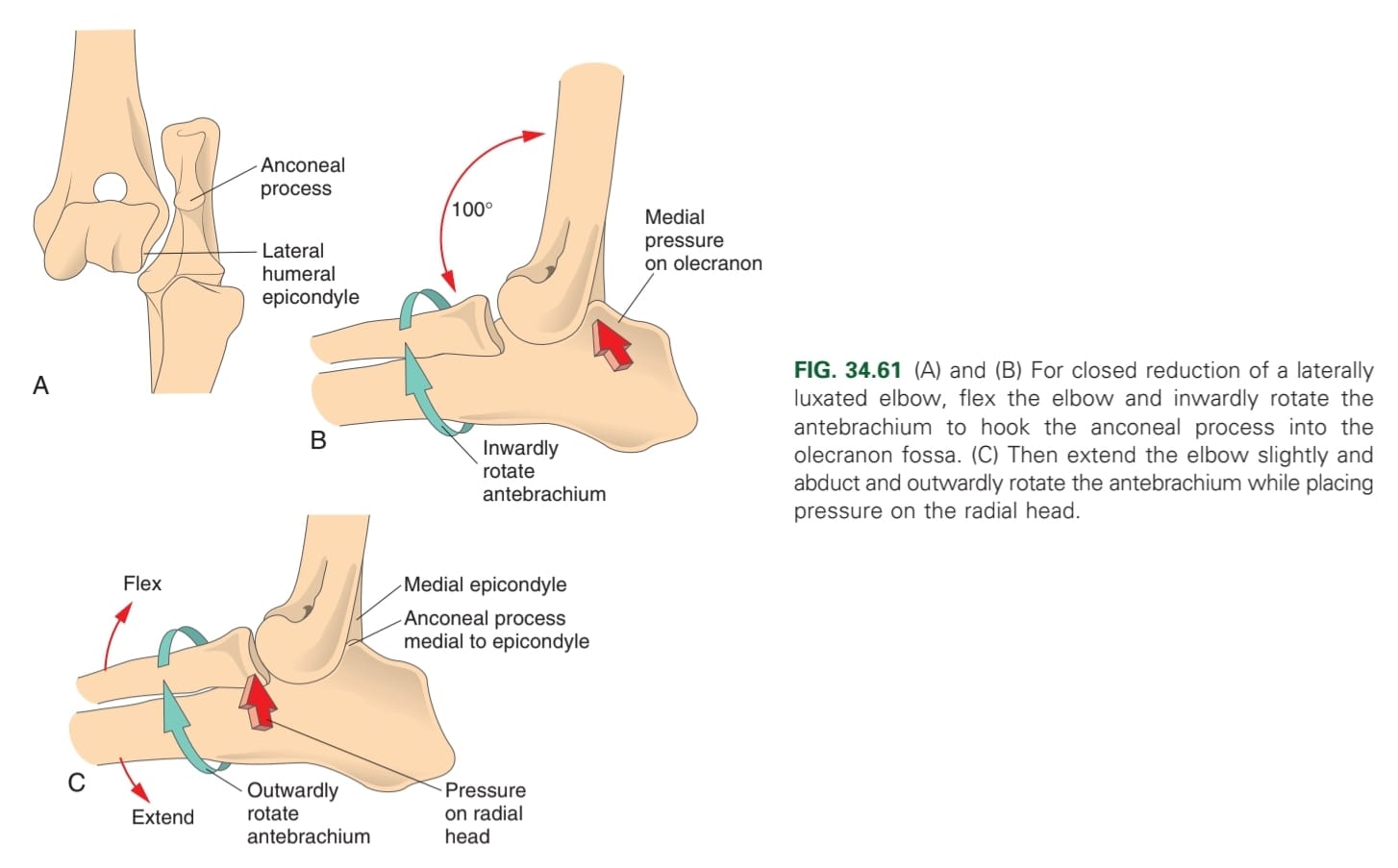 <p>Animal under general anaesthesia, &amp; firm palpation is used to position humeral condyles relative to radius &amp; ulna. </p><p>Pressure of reduction is based on position of anconeal process, medial to lateral epicondylar crest (medial pressure on olecranon while flexion), lateral to lateral epicondyle (flexion, antebrachium twisted inward, extend joint &amp; flex while medial pressure on radial head)</p>