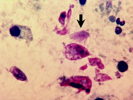 <p>Comment s’appelle ce phénomène (photo) </p><p>Il est associé à quel pathologie </p>