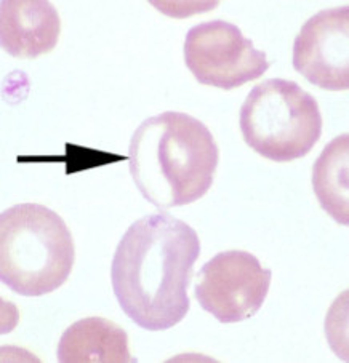 <p>central pallor is pushed to one side</p><p>- usually seen with Heinz bodies</p>