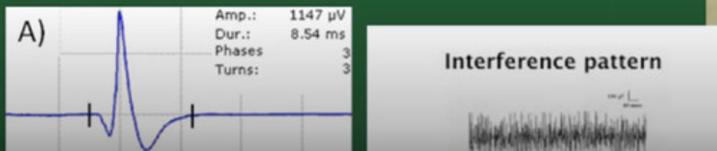 <p>1. Needle Insertion: Brief burst electrical activity</p><p>2. At Rest: Electrical silence</p><p>3. Minimal Effort: Typical MUP's with normal values</p><p>4. Maximal Effort: Full interference pattern</p>