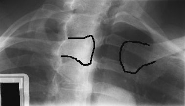 <p>Is this under or over rotated - OBL SC joint</p>