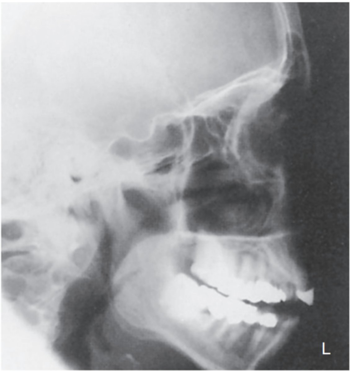 <p>-Position: </p><p>• Accurately positioned cranium without rotation or tilt. </p><p>• Rotation is evident by anterior and posterior separation of symmetric bilateral vertical structures such as the mandibular rami and greater wings of the sphenoid. </p><p>• Tilt is evident by superior and inferior separation of symmetric horizontal structures such as the orbital roofs (plates) and greater wings of sphenoid</p>