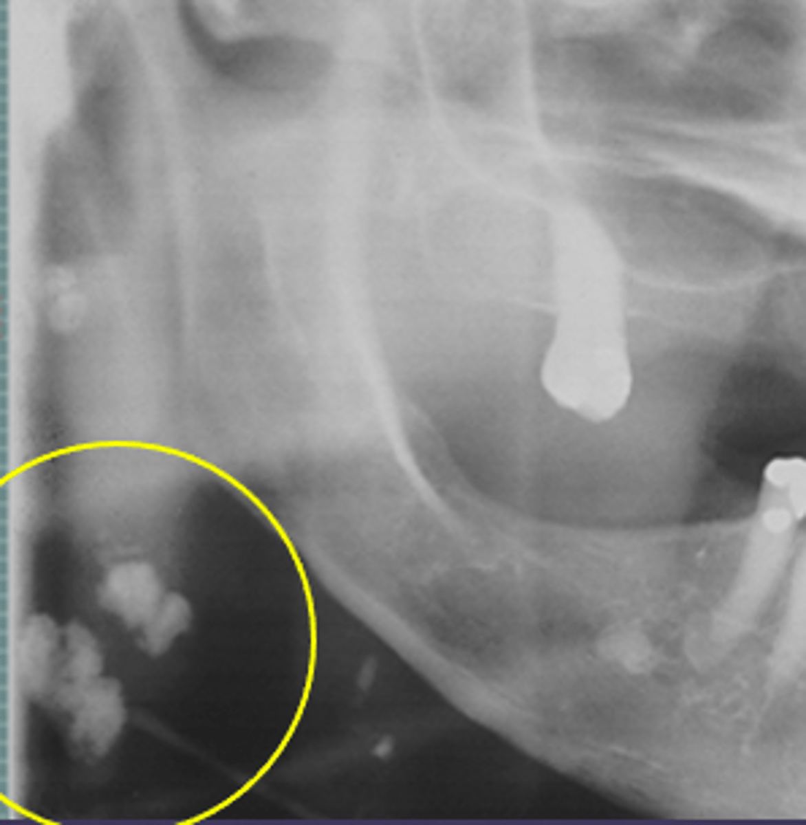 <p>ID the calcified abnormality:</p>