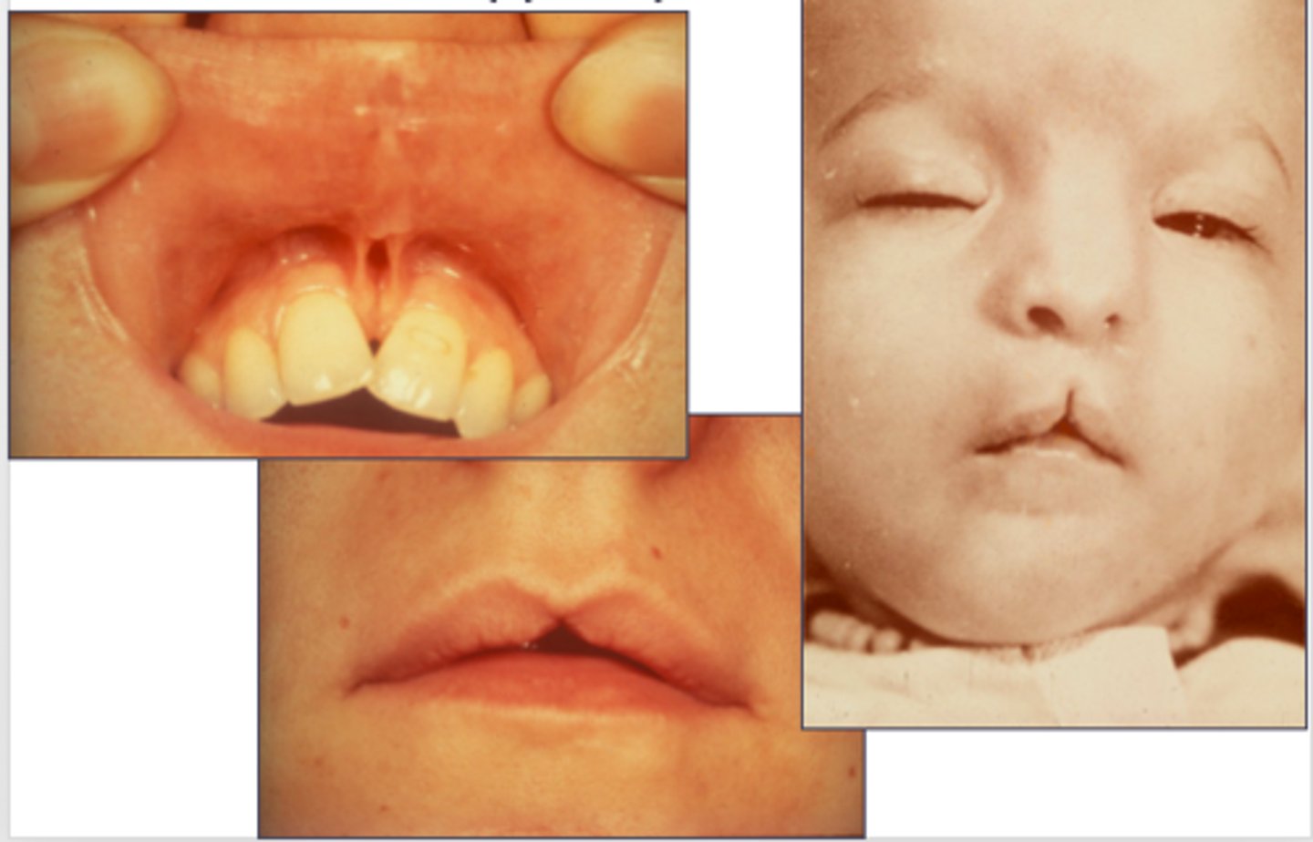 <p>Median cleft of the upper lip (rare) is failure of fusion of what? </p>