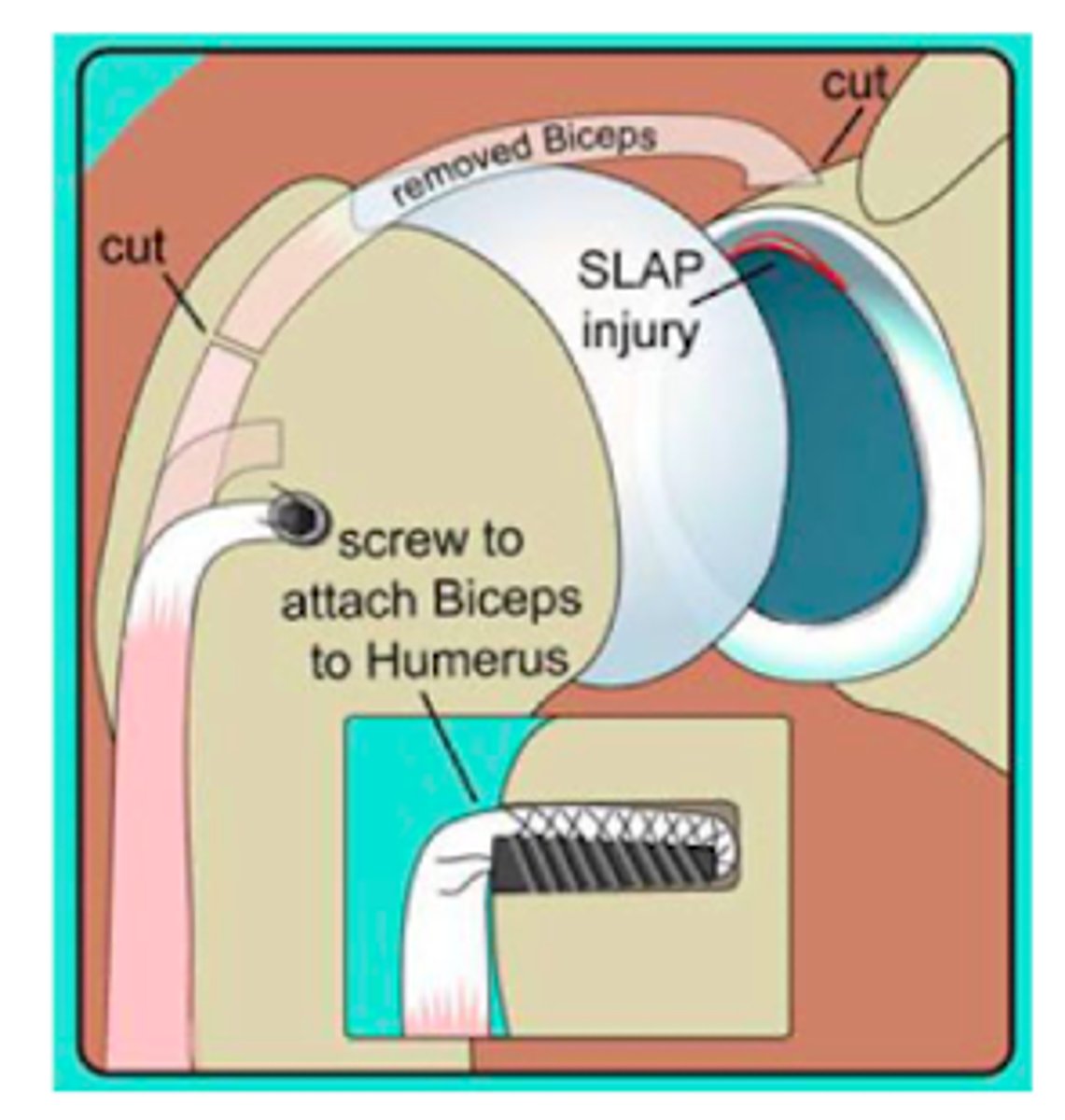 <p>consists of cutting the normal attachment of the biceps tendon on the shoulder socket and reattaching the tendon to the arm bone (humerus)</p>