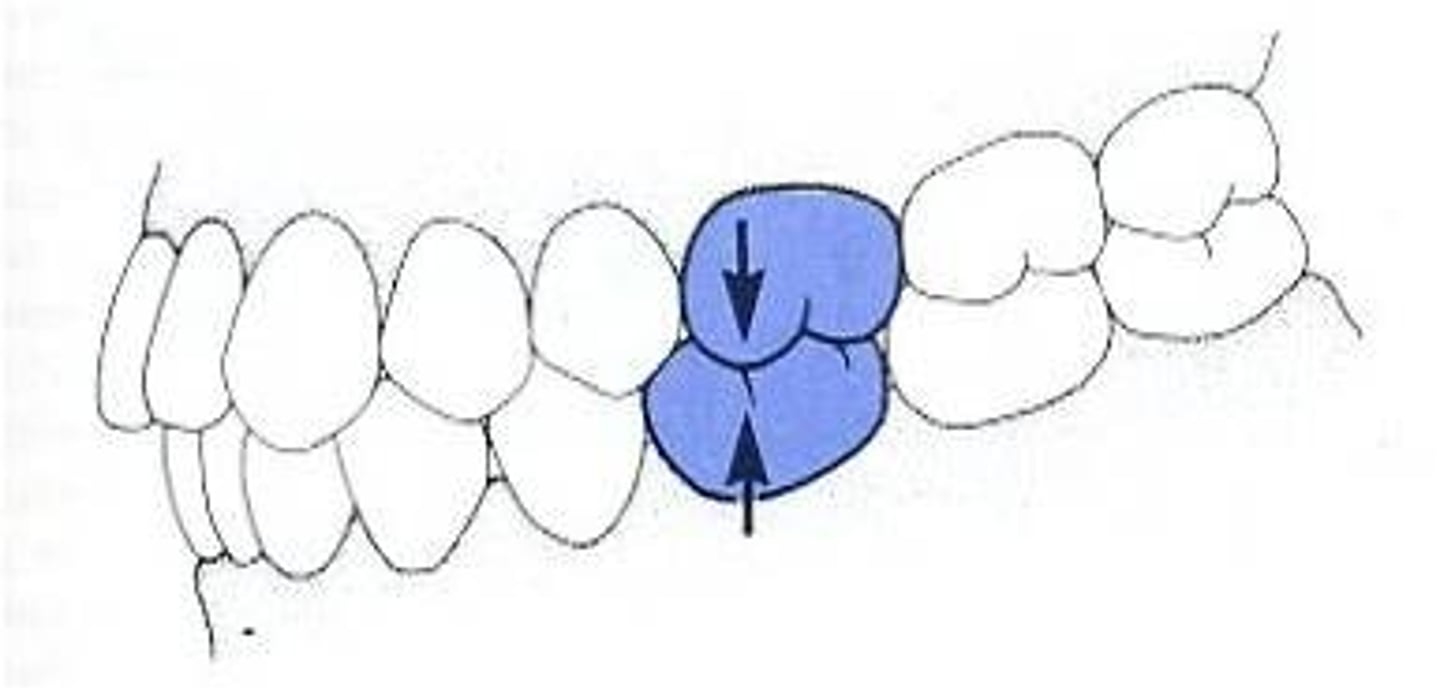 <p>the central fossa of the mandibular first molar</p>
