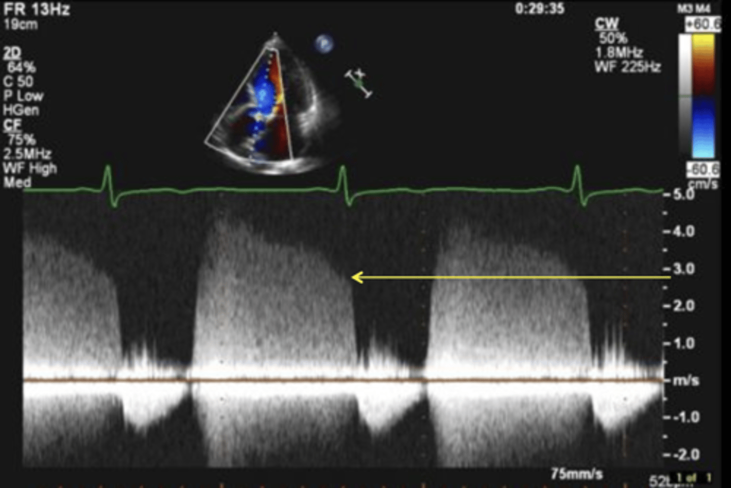 <p>End-diastolic AI velocity</p><p>Diastolic BP</p>