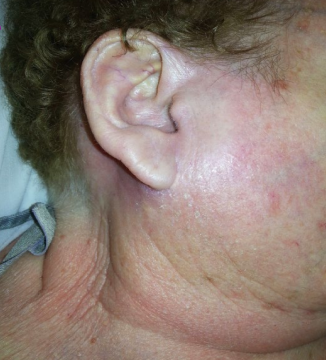 <p><strong>Diagnosis and Treatment of Suppurative Parotitis</strong></p><p>-__________ is imaging of choice (CT as supplement), serum ________ will be elevated, and gram stain/cultures can be done</p><p>-Admit for IV ________ and hydration: ampicillin-sulbactam is a common course of treatment</p><p>-Aspiration or I&amp;D if _______ forms </p>