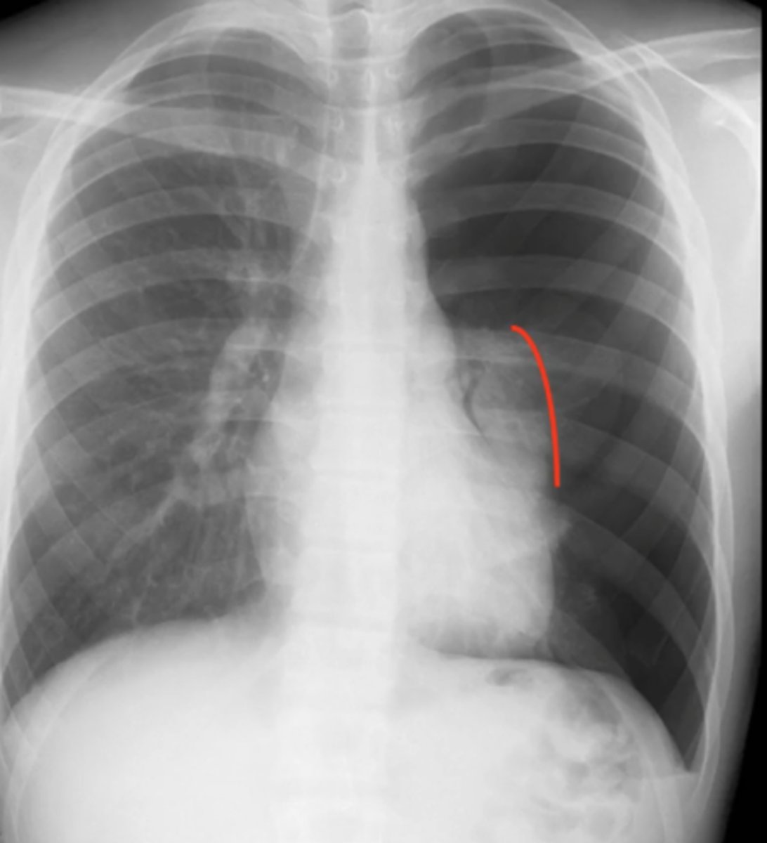 <p>(CXR examples) large loss of air markings on the right side; rest of lung is filled with only air</p>