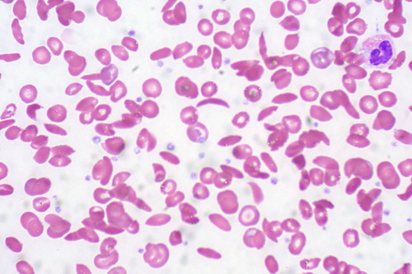 <p>Condition where red blood cells are skinny and irregularly shaped</p>