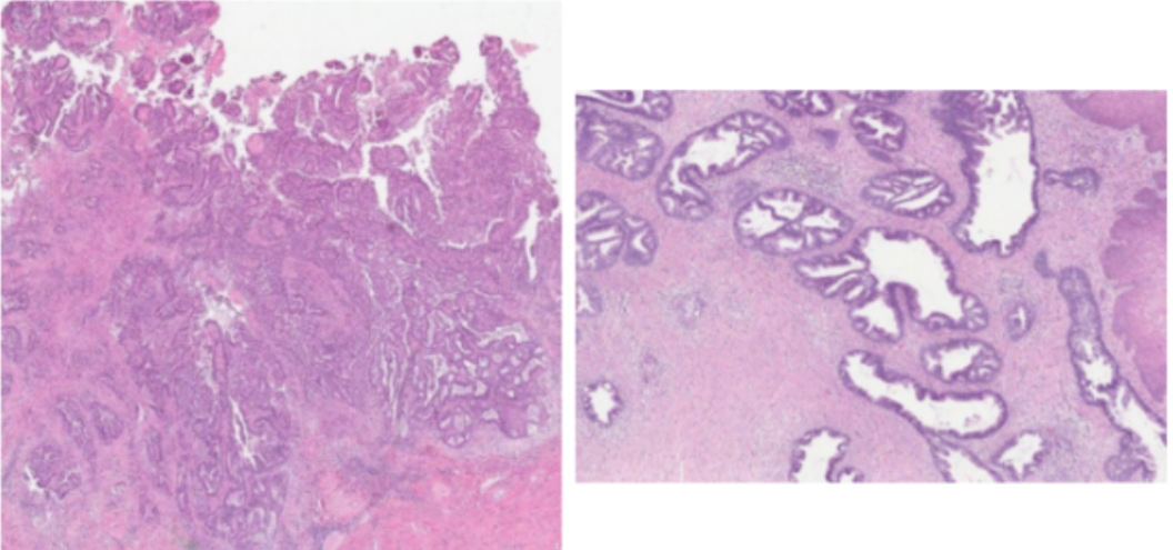 <p><span>Femenina de 47 años de edad con sangrado trasvaginal, historia de citología ginecológica con HPV de alto riesgo positivo. Se toma biopsia de lesión cervical que protruye por el canal y muestra las siguientes características microscópicas</span></p>