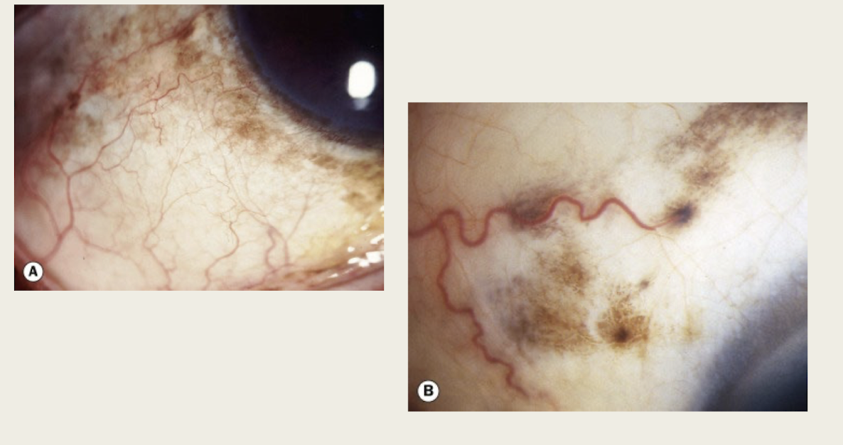 <p>Bilateral condition (can be asymmetric) </p><p>flat + patchy brown pigmentation</p>