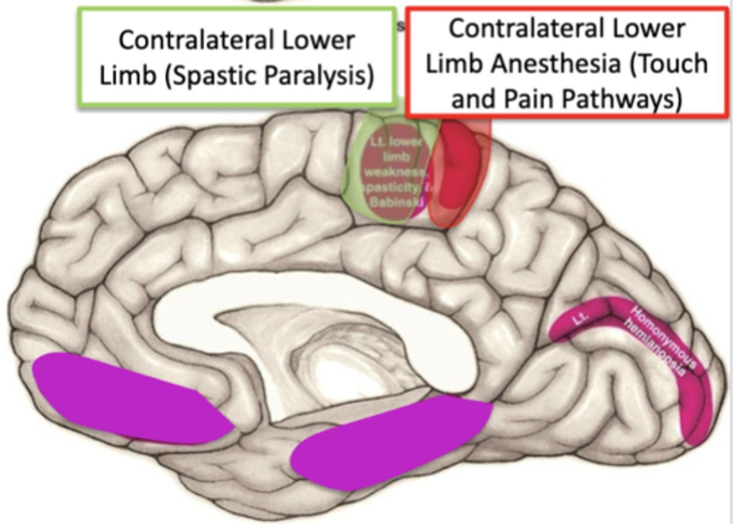 <p>spastic paralysis in the contralateral lower extremity (hyperreflexia, Babinski response, spasticity) </p>