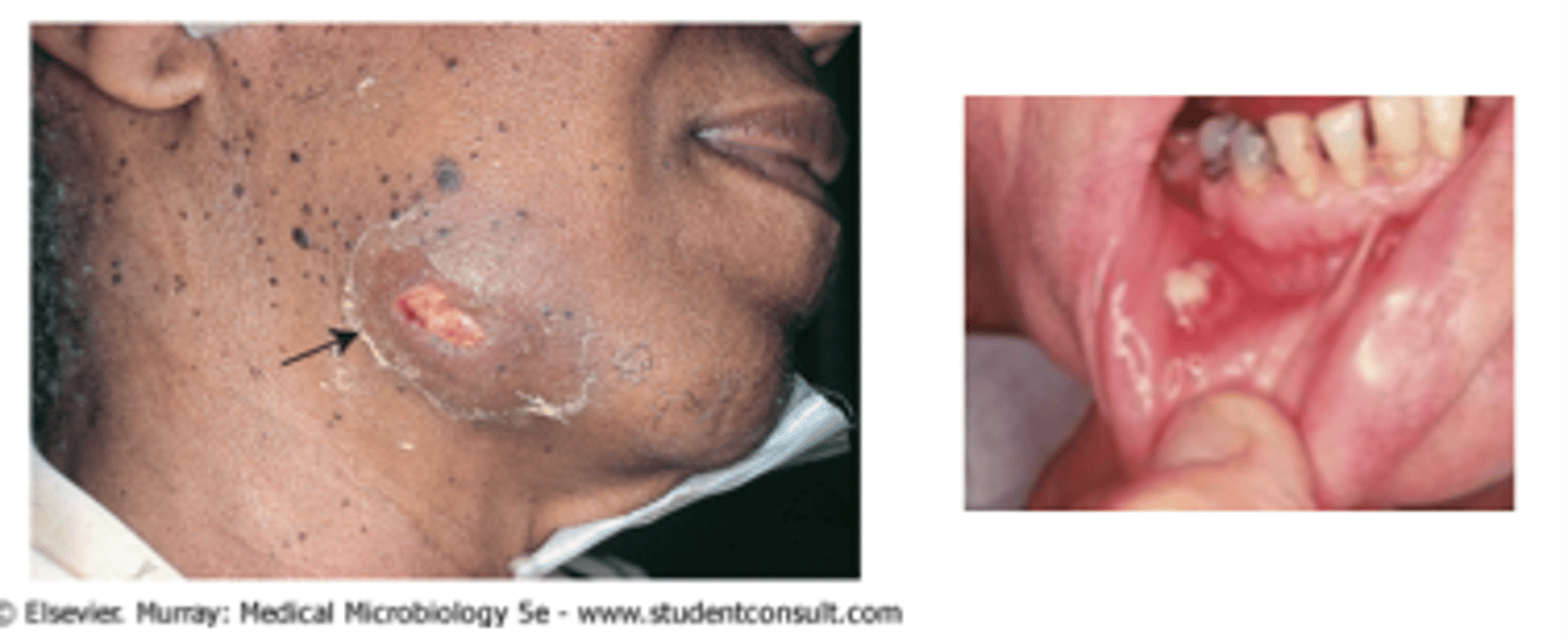 <p>Draining abscesses, "sulfur granules"</p>