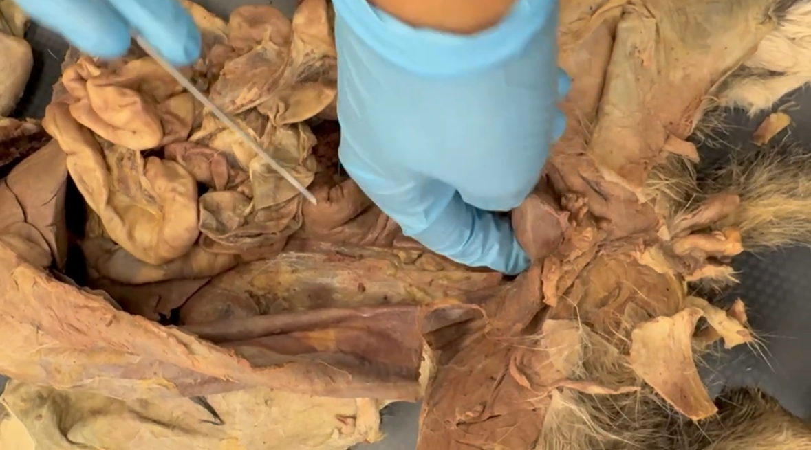 <p>Finger is digging where - underneath/past bladder - transverse colon leads into it</p>