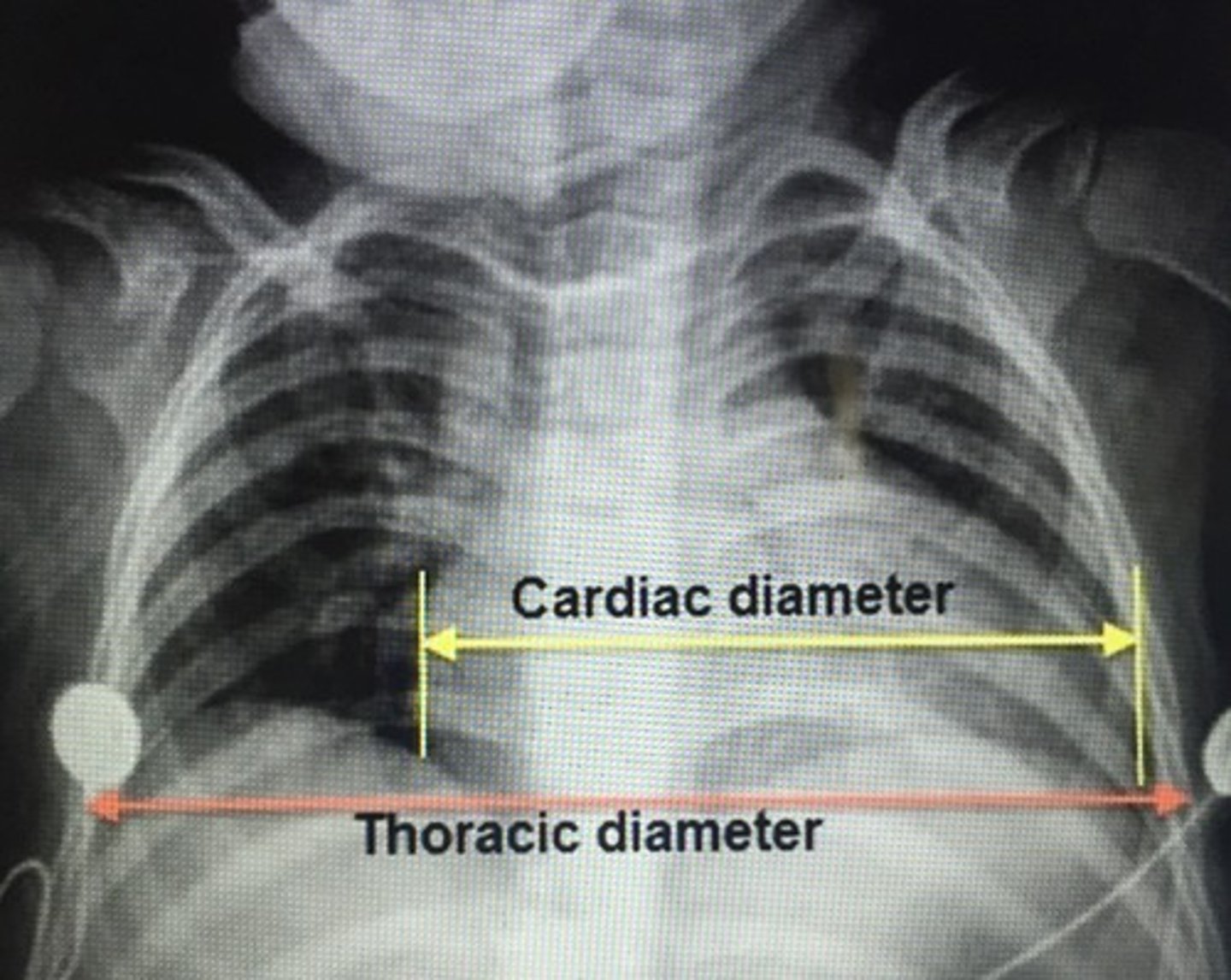 <p>Pediatric viral myocarditis</p><p>- Coxsackie B virus</p><p>- Adenovirus</p><p>Endomyocardial biopsy (gold standard): inflammatory infiltrate of myocardium w/ myocyte necrosis</p><p>Tx: Diuretics + inotropes, affected children monitor ICU due to risk of shock and fatal arrhythmias</p>