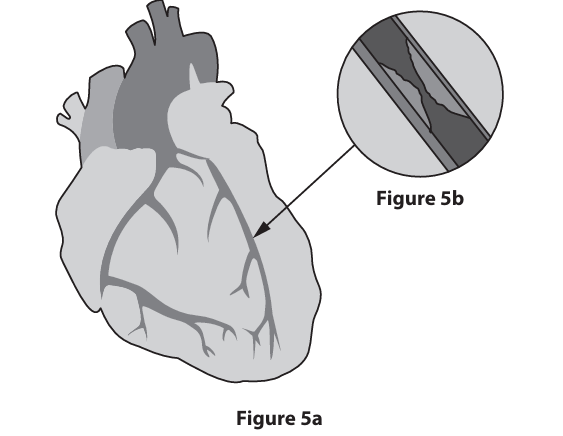 <p>Figure 5a shows the external structure of a human heart. Figure 5b shows a blocked coronary artery.</p><p>State what is meant by the term myogenic. (2)</p>