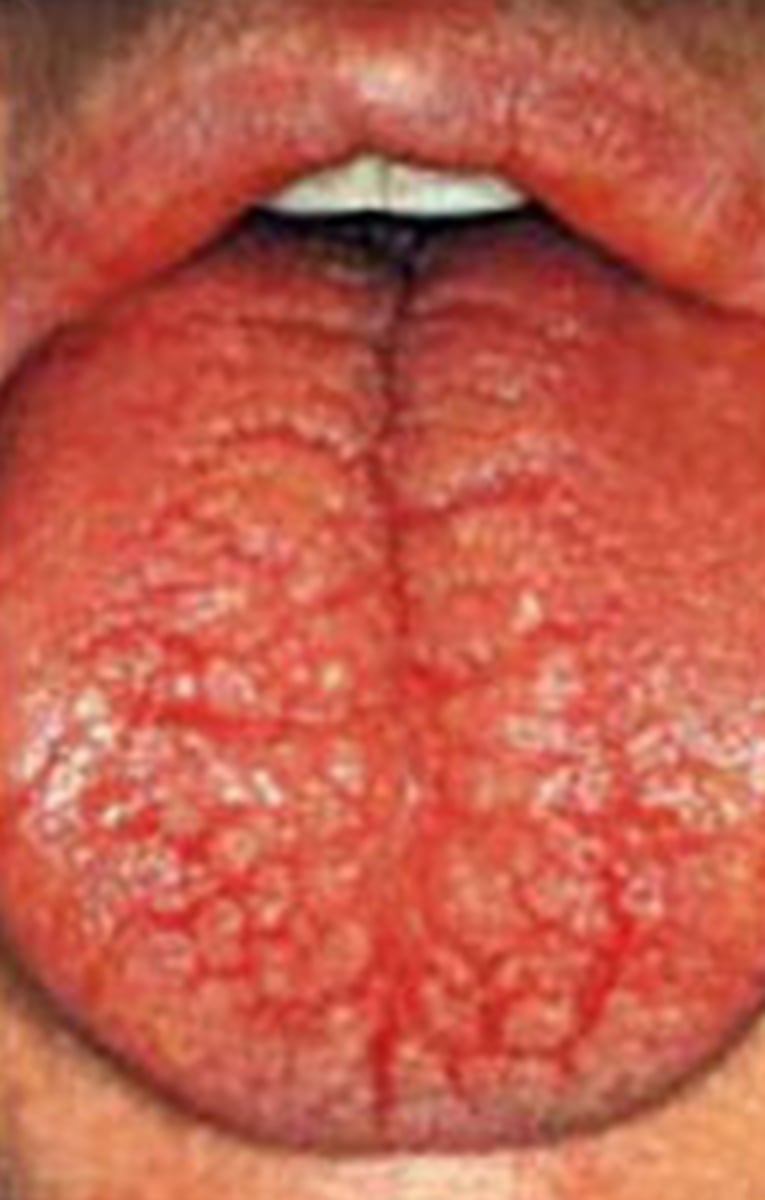 <p>dry mouth when the oral mucosa becomes drier as saliva production decreases (a common side effect of many medications)</p>