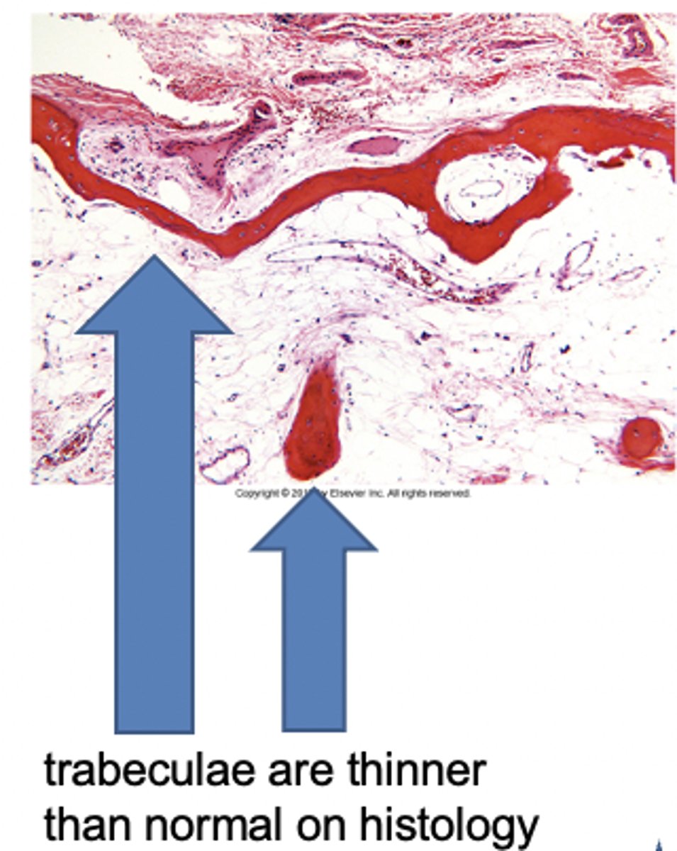 <p>trabeculae<br>microfracture</p>