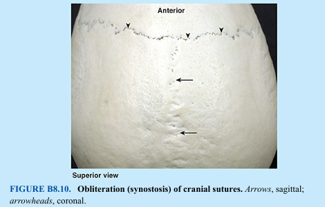 <p>The obliteration of sutures between the bones of the calvaria usually begins between the ages of 30 and 40 years on the internal surface. Approximately 10 years later, the sutures on the external surface obliterate (Fig. B8.10; cf. Fig. 8.8B). Obliteration of sutures usually begins at the bregma and continues sequentially in the sagittal, coronal, and lambdoid sutures. Closure times vary considerably. </p>