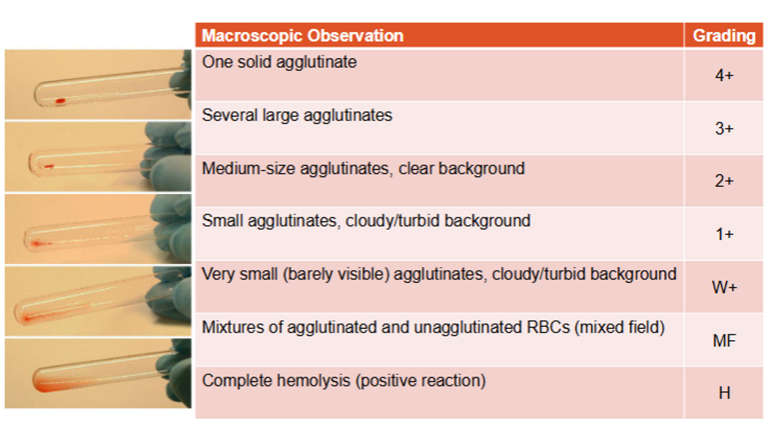 <ul><li><p>negative (0): cells fail to show visible agglutination after button dislodges</p></li><li><p>1+: hazy red background with many small agglutinates available</p></li><li><p>2+: clear bkg w medium sized agglutinates</p></li><li><p>3: clear bkg w fewer than 5 larger clumps</p></li><li><p>4+: one large clump or one large and one smaller clump w clear bkg (no free cells)</p></li></ul><p></p>